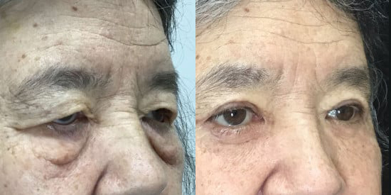 Ectropion (Loose Lower Eyelids) before and after photo by Kristin J. Tarbet, M.D. in Bellevue, WA