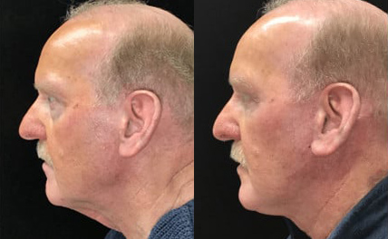 Neck Liposuction and Rejuvenation before and after photo by Kristin J. Tarbet, M.D. in Bellevue, WA