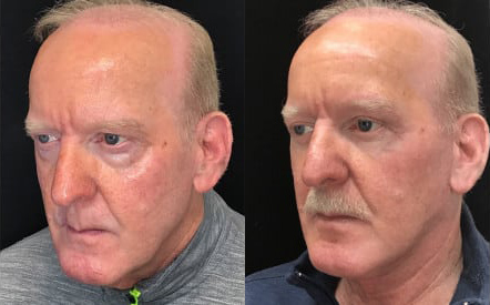 Neck Liposuction and Rejuvenation before and after photo by Kristin J. Tarbet, M.D. in Bellevue, WA