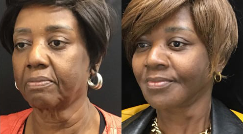 Neck Liposuction and Rejuvenation before and after photo by Kristin J. Tarbet, M.D. in Bellevue, WA