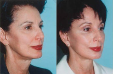 Neck Liposuction and Rejuvenation before and after photo by Kristin J. Tarbet, M.D. in Bellevue, WA