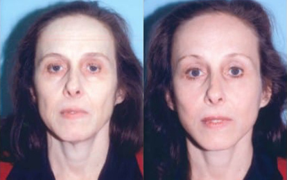 Neck Liposuction and Rejuvenation before and after photo by Kristin J. Tarbet, M.D. in Bellevue, WA Neck Liposuction and Rejuvenation before and after photo by Kristin J. Tarbet, M.D. in Bellevue, WA
