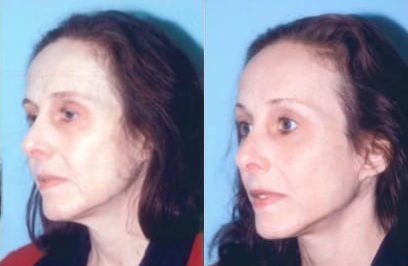 Neck Liposuction and Rejuvenation before and after photo by Kristin J. Tarbet, M.D. in Bellevue, WA