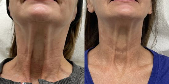 Xeomin for neck bands before and after photo by Kristin J. Tarbet, M.D. in Bellevue, WA