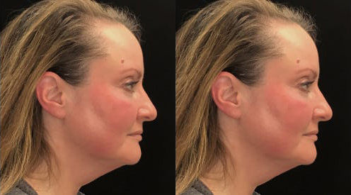 FaceTite before and after photo by Kristin J. Tarbet, M.D. in Bellevue, WA