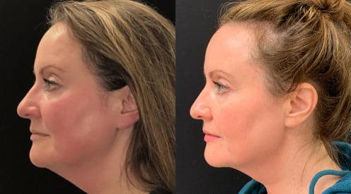 FaceTite before and after photo by Kristin J. Tarbet, M.D. in Bellevue, WA