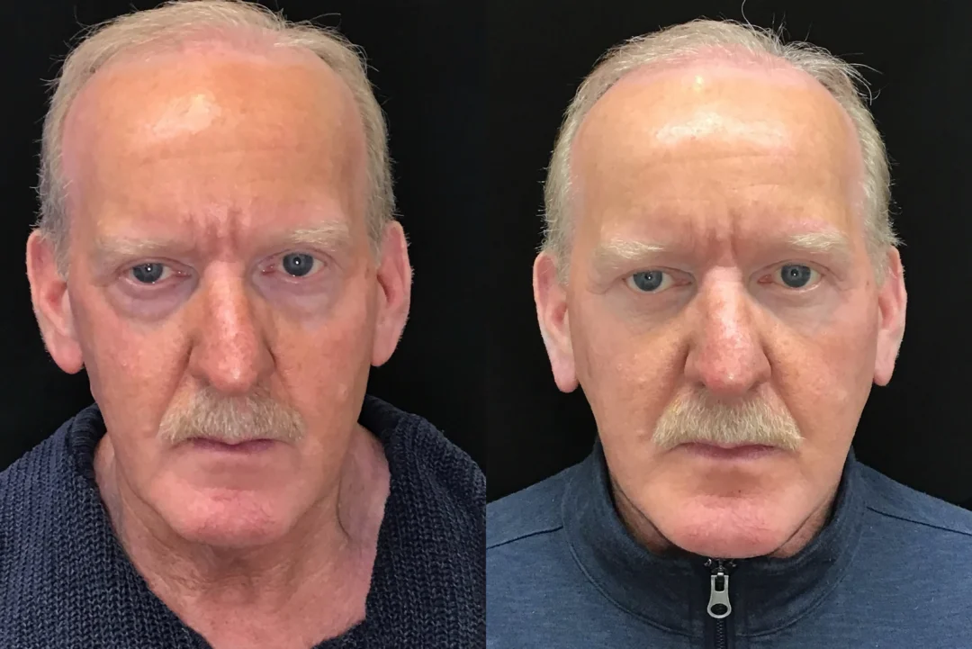 Front View Facelift, Blepharoplasty, Cheek Lift, Neck Liposuction before and after photo by Dr. Tarbet