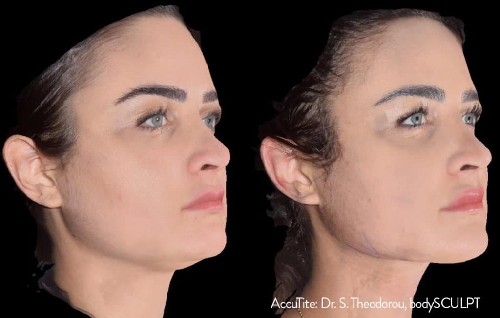 accutite before after accutite before after