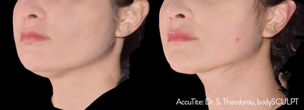 accutite before after accutite before after
