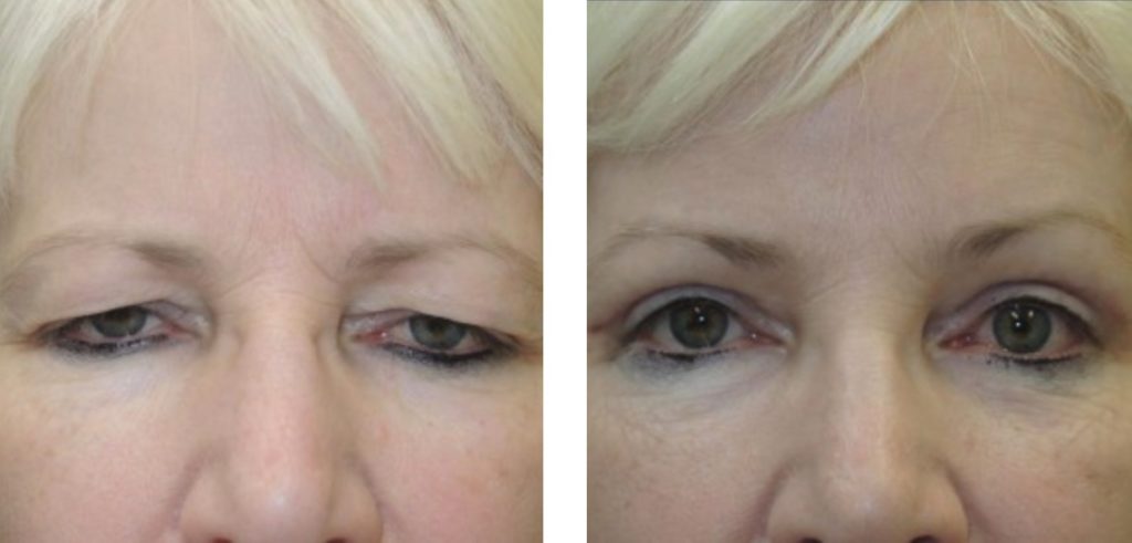 blepharoplasty before and after performed by kristin j tarbet md blepharoplasty before and after performed by kristin j tarbet md