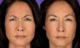botox before and after botox before and after