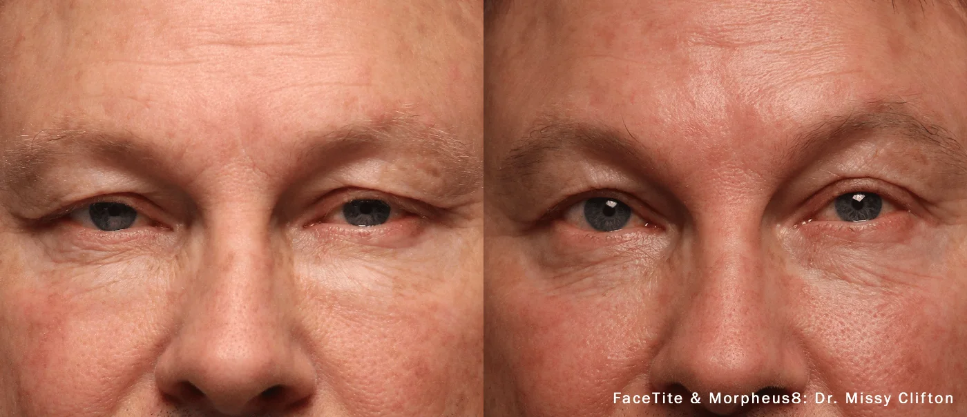 facetite before and after facetite before and after