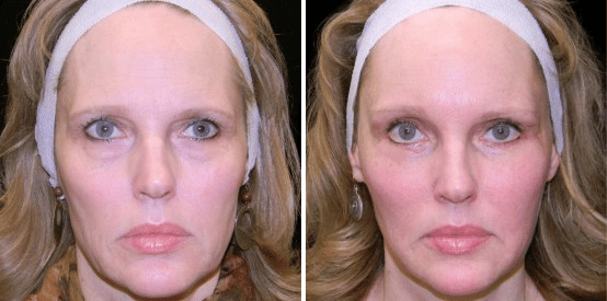 fat transfer before and after fat transfer before and after