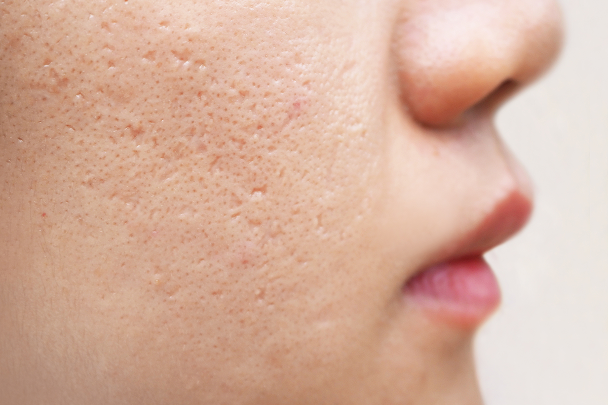 Icepick scars acne on cheek on face women cause of happen because of skin loses collagen