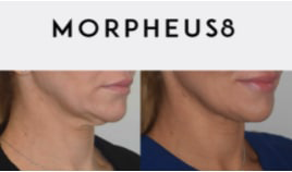 Morpheus8 results