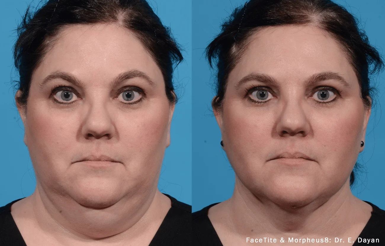 morpheus before and after morpheus before and after