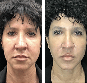 morpheus before and after morpheus before and after
