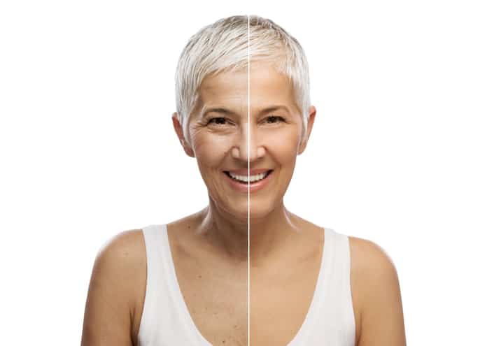 smiling mature woman before after bellafill smiling mature woman before after bellafill