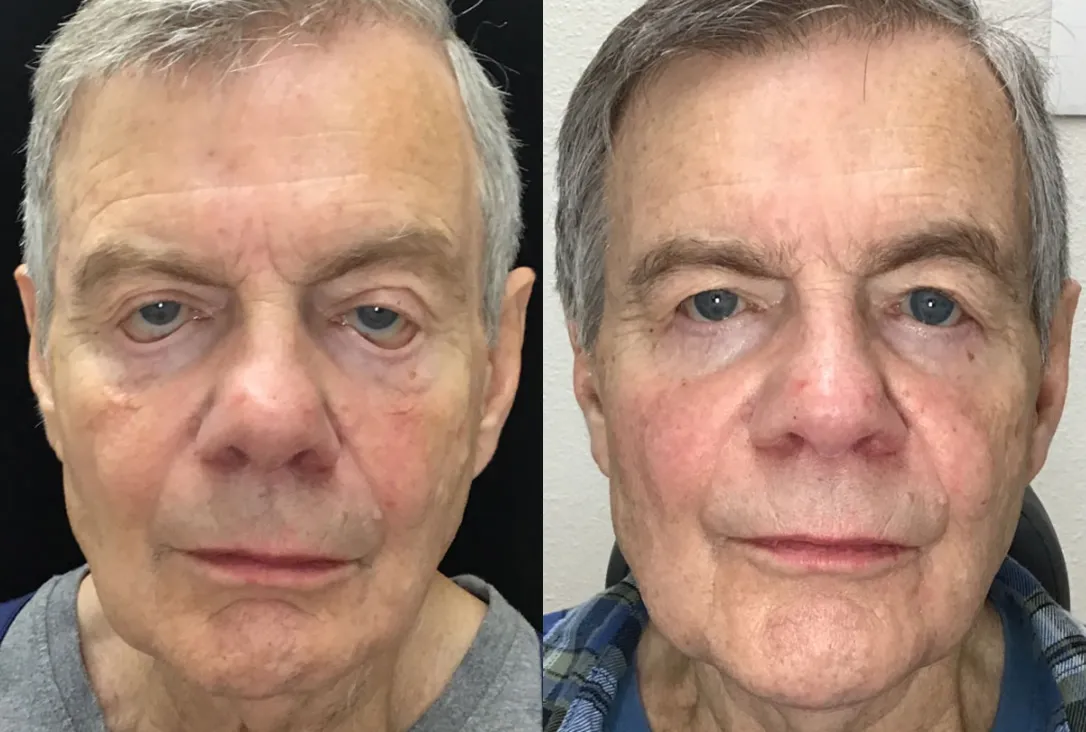 Ectropion Repair before and after photo by Kristin J Tarbet MD in Bellevue WA