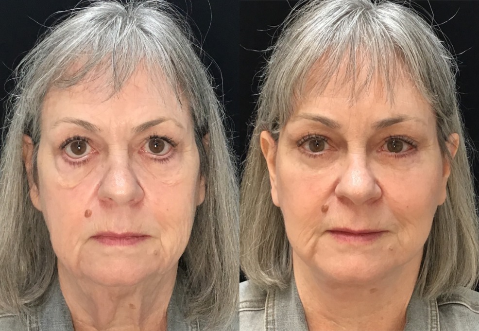 Facelift, Neck Liposuction before and after photo by Kristin J Tarbet MD in Bellevue WA