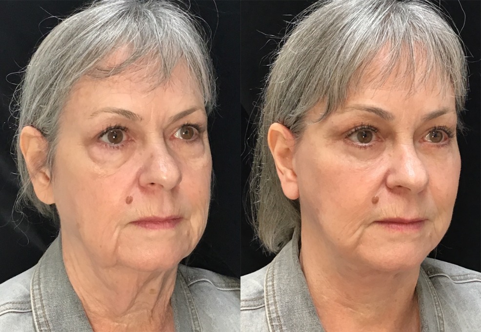 Facelift, Neck Liposuction before and after photo by Kristin J Tarbet MD in Bellevue WA