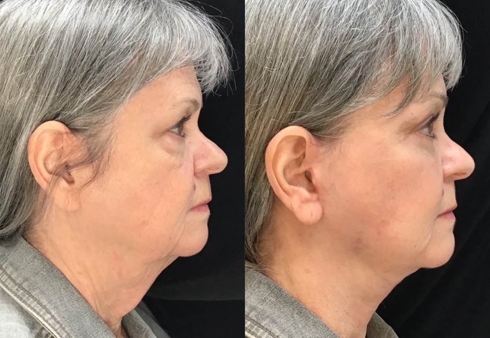 Facelift, Neck Liposuction before and after photo by Kristin J Tarbet MD in Bellevue WA