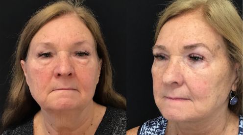 Facelift, Necklift before and after photo by Kristin J. Tarbet, M.D. in Bellevue, WA