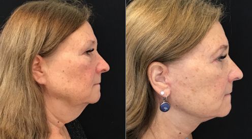 Facelift, Necklift before and after photo by Kristin J. Tarbet, M.D. in Bellevue, WA