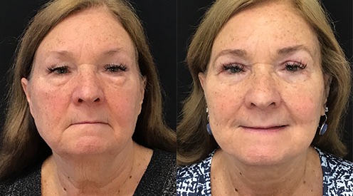 facelift before and after photo by kristin j tarbet md in bellevue wa