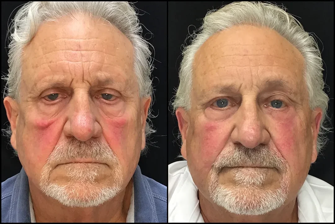 BLL Bleph, Cheeklift, BUL CM, BLL Ectropion Repair, Endobrow before and after photo by Kristin J Tarbet MD in Bellevue WA