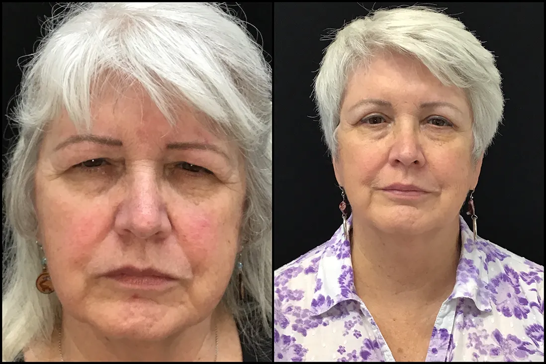 BUL Bleph, Endobrow before and after photo by Kristin J Tarbet MD in Bellevue WA