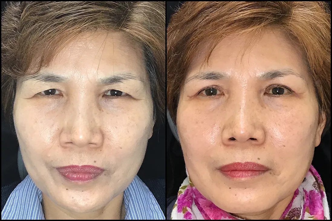 BUL Bleph before and after photo by Kristin J Tarbet MD in Bellevue WA