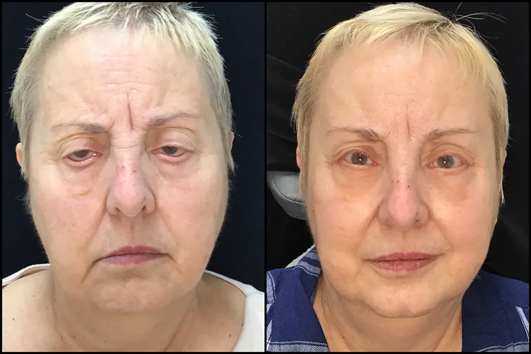 BUL CM, BLL Ectropion, BLL Bleph, Cheeklift, Endobrow before and after photo by Kristin J Tarbet MD in Bellevue WA