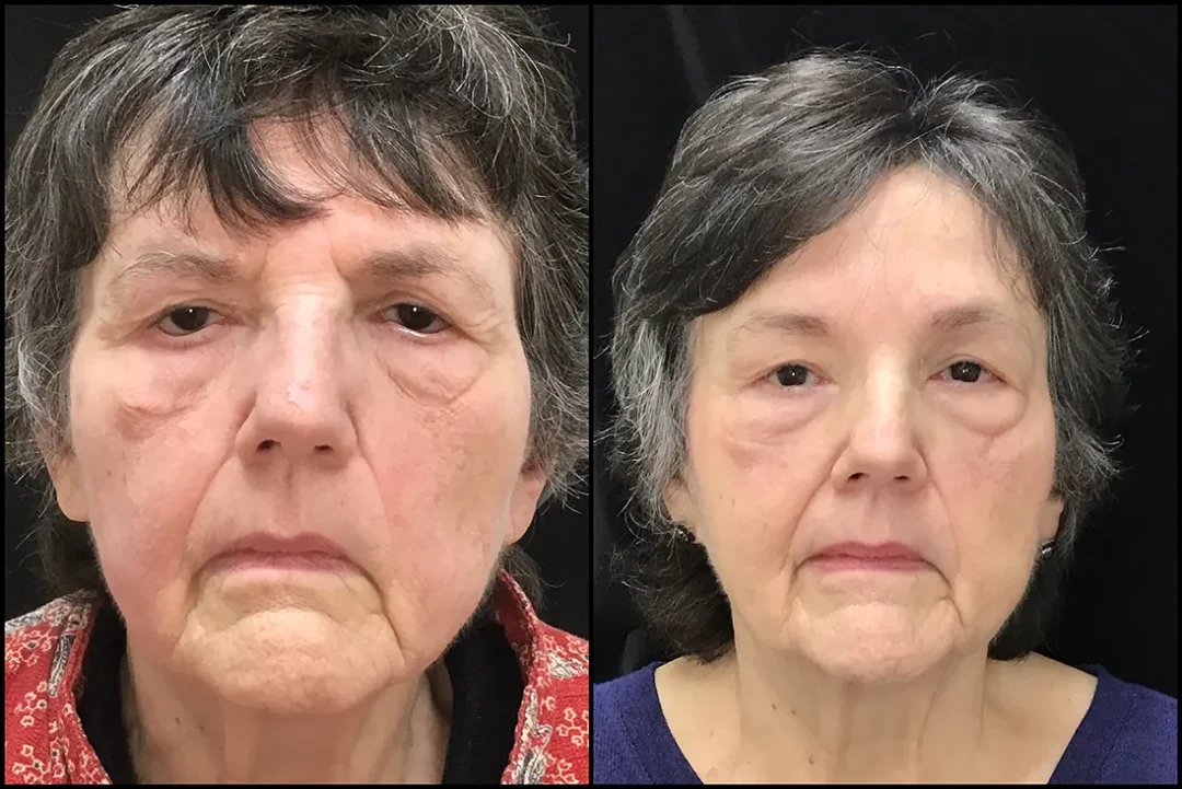 BUL CM, BLL Ectropion Repair, Endobrow before and after photo by Kristin J Tarbet MD in Bellevue WA