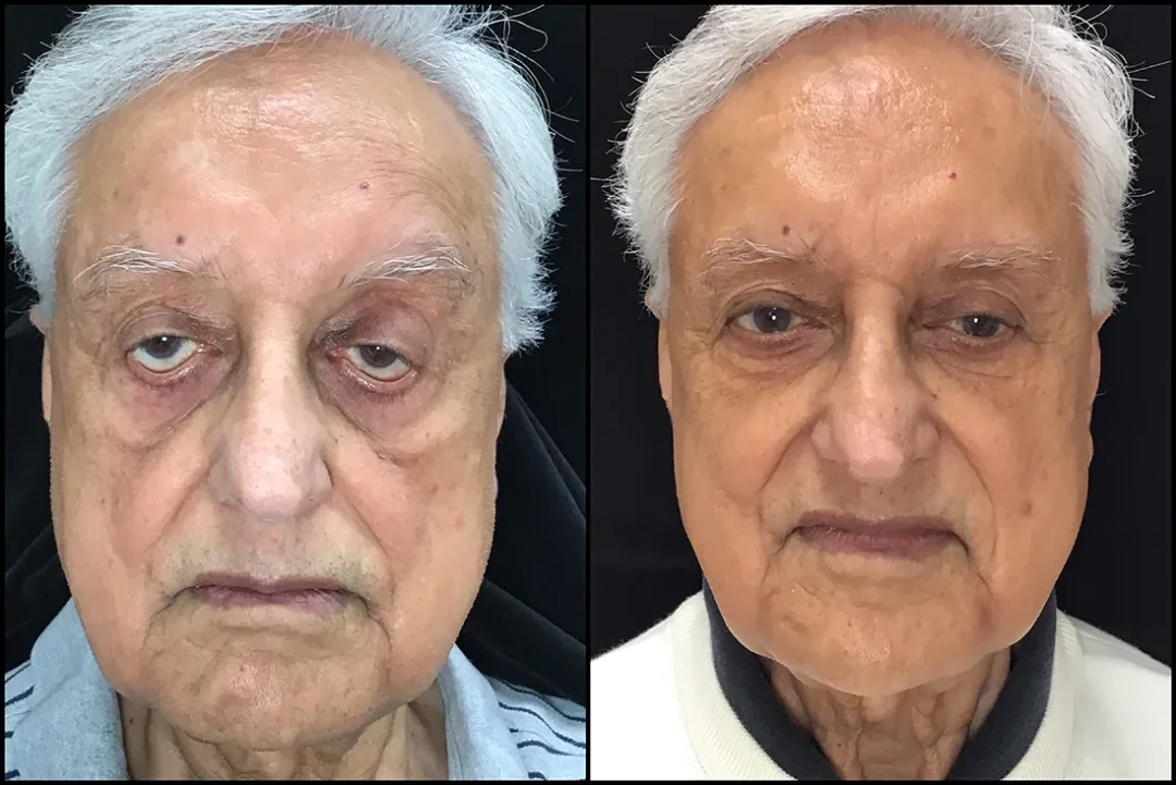 BUL CM, BLL, Ectropion Repair, Possible BUL Bleph before and after photo by Kristin J Tarbet MD in Bellevue WA