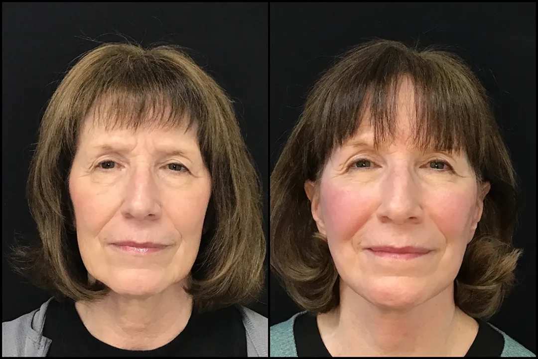 BUL CM before and after photo by Kristin J Tarbet MD in Bellevue WA