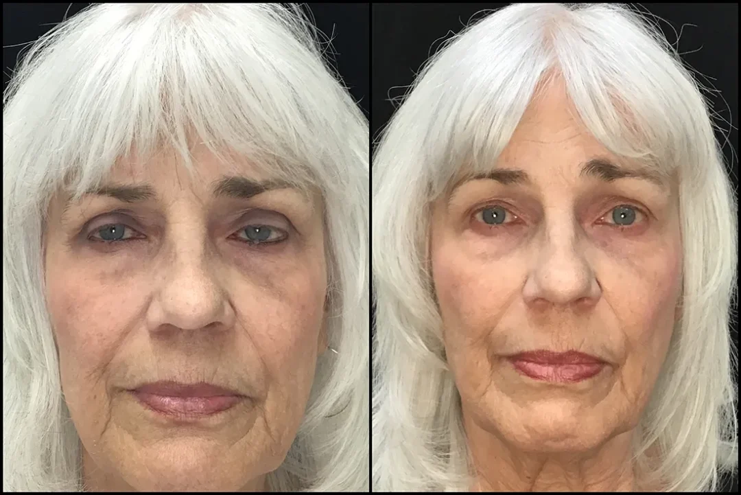 BUL CM before and after photo by Kristin J Tarbet MD in Bellevue WA