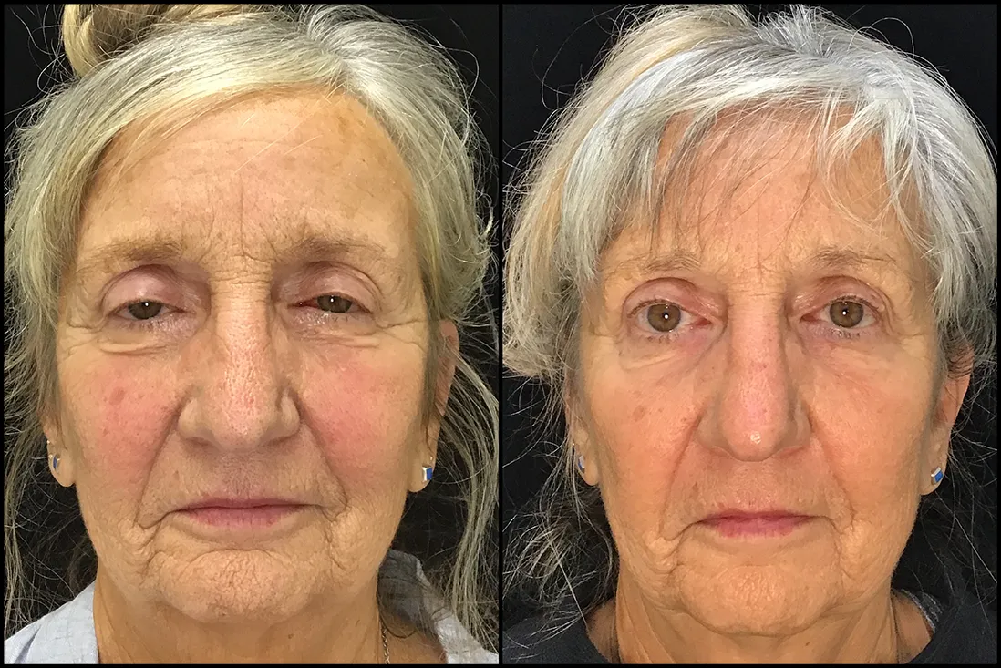 BUL CM before and after photo by Kristin J Tarbet MD in Bellevue WA