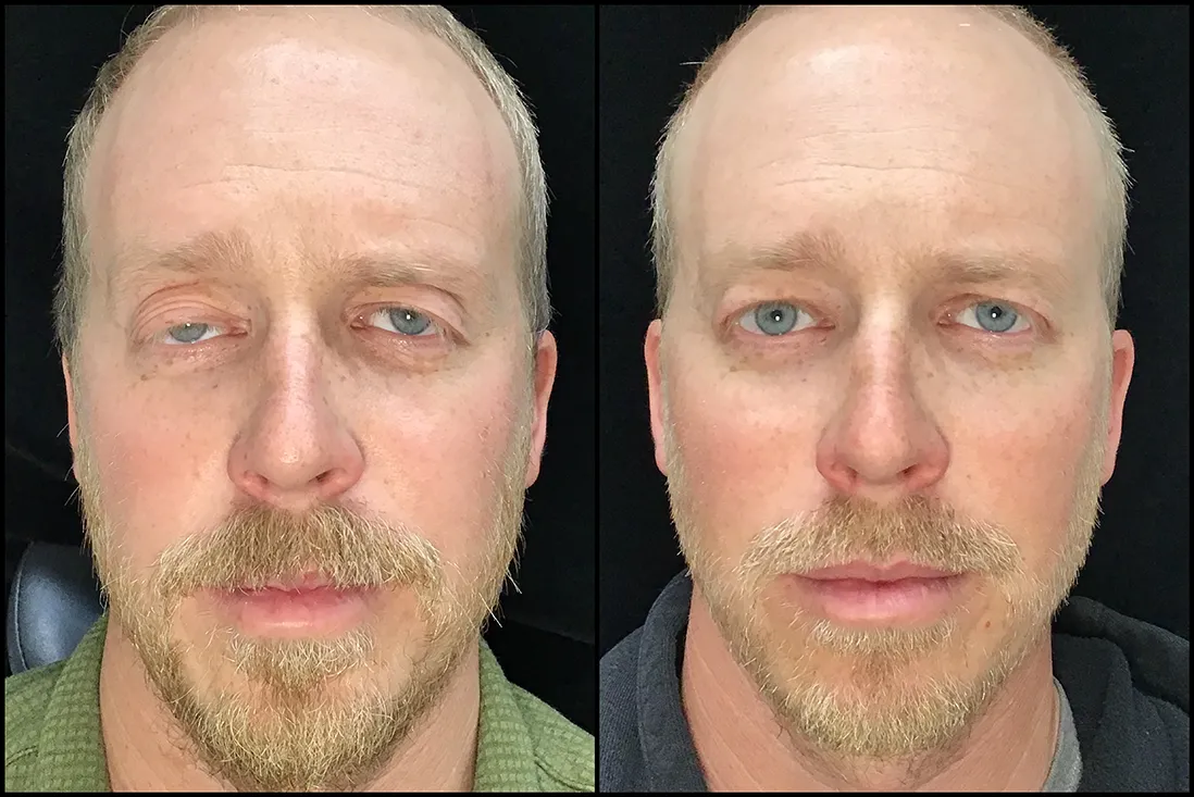 BUL Levator Repair before and after photo by Kristin J Tarbet MD in Bellevue WA