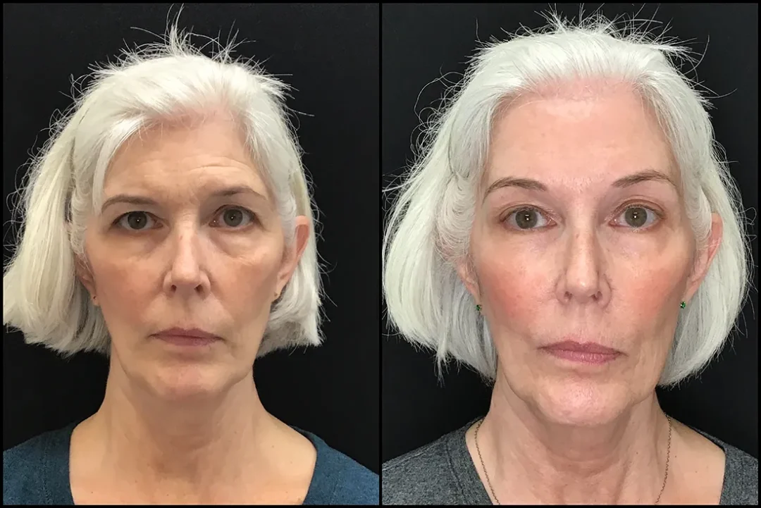 Brow Lift before and after photo by Kristin J Tarbet MD in Bellevue WA