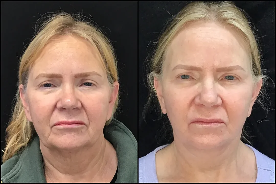 Facelift, Neck Lipo, Cheeklift before and after photo by Kristin J Tarbet MD in Bellevue WA