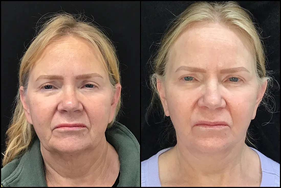 Facelift, Neck Lipo, Cheeklift before and after photo by Kristin J Tarbet MD in Bellevue WA