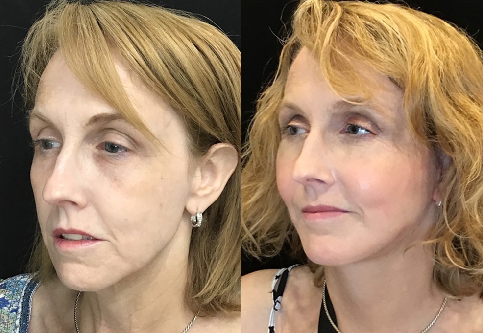Facelift before and after photo by Kristin J Tarbet MD in Bellevue WA
