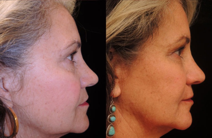Juvederm & Belotero before and after photo by Kristin J Tarbet MD in Bellevue WA