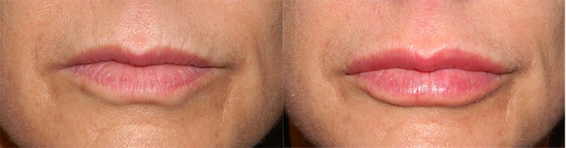 Lip Filler before and after photo by Kristin J Tarbet MD in Bellevue WA