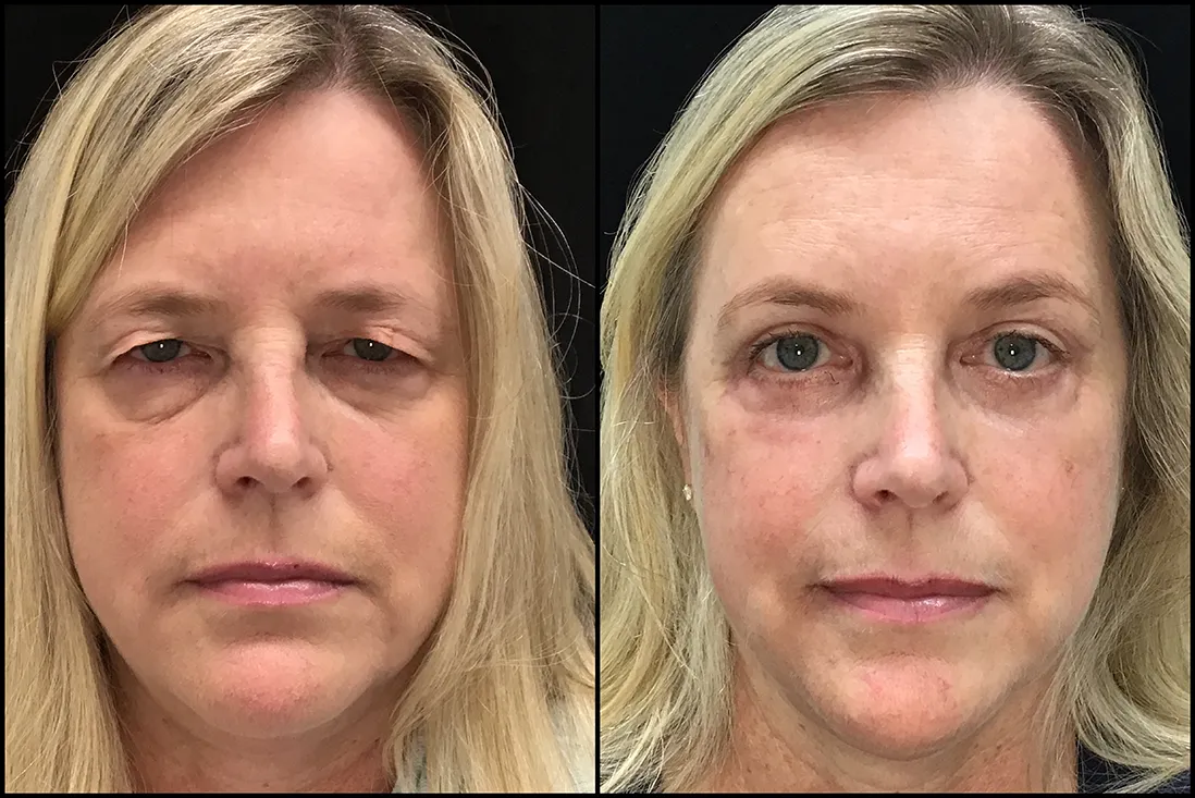 Quad Bleph before and after photo by Kristin J Tarbet MD in Bellevue WA