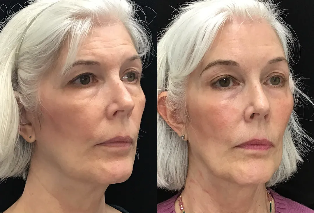 Right Oblique View Brow Lift before and after photo by Dr. Tarbet