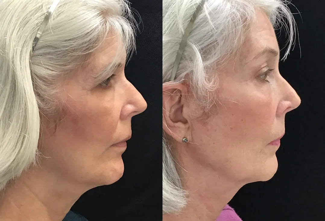 Right Side View Brow Lift before and after photo by Dr. Tarbet