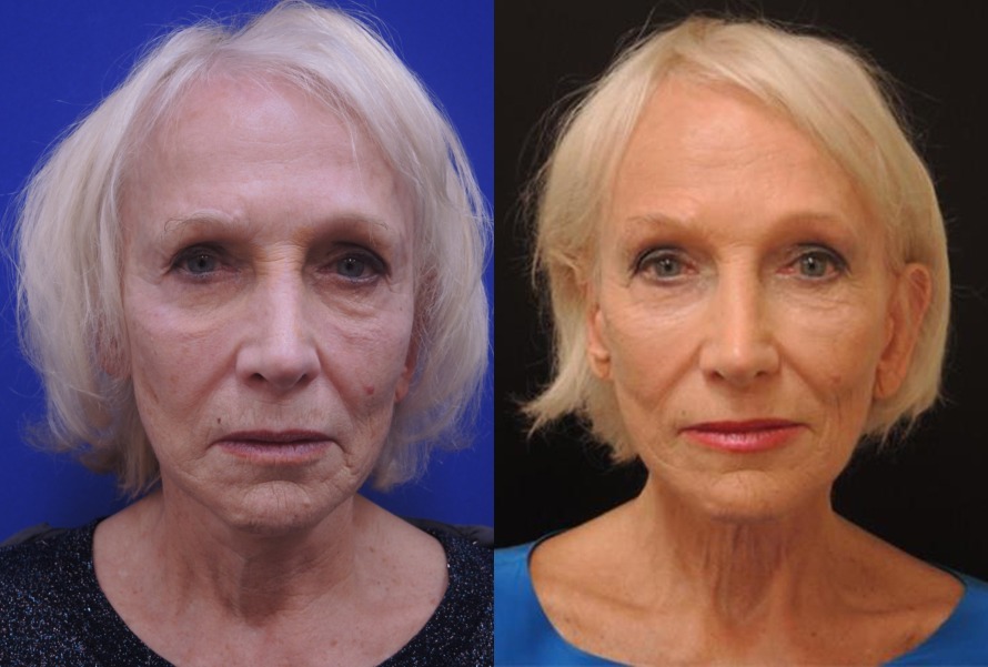 Sculptra before and after photo by Kristin J Tarbet MD in Bellevue WA