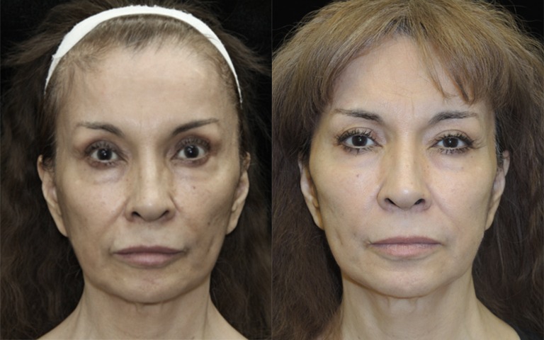 Sculptra before and after photo by Kristin J Tarbet MD in Bellevue WA